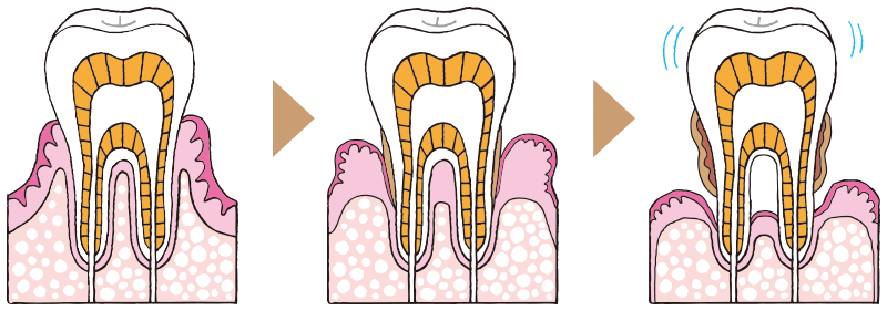 歯周病・歯槽膿漏の進行